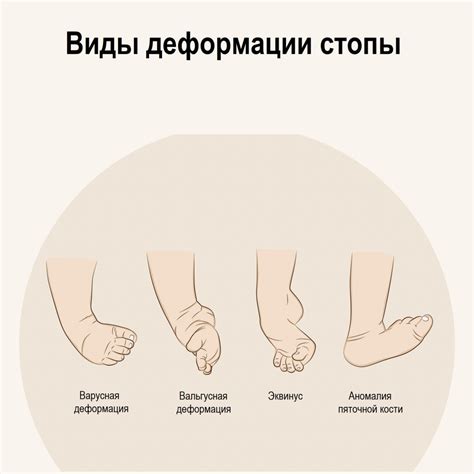 Деформация