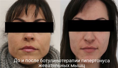 Постоянное перенапряжение мышц лица