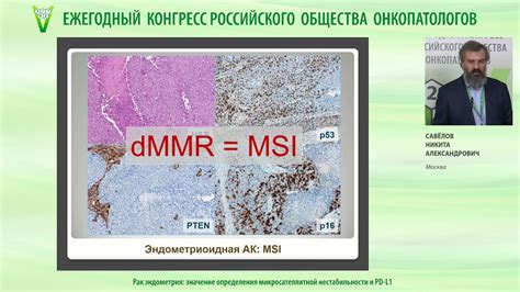 Диагностическое значение отсутствия признаков микросателлитной нестабильности