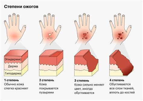 Риск для здоровья при взаимодействии с уксусом 9%: последствия ожогов слизистой оболочки горла