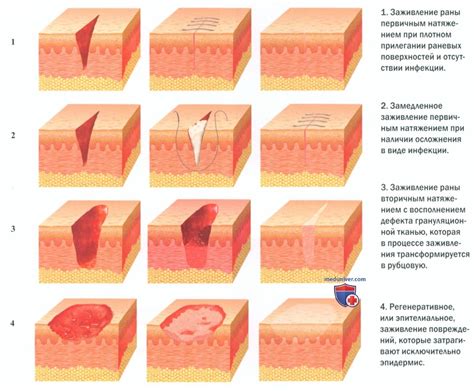 Эффективное заживление раны