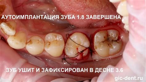 Важные моменты при удалении биндов: последствия и рекомендации