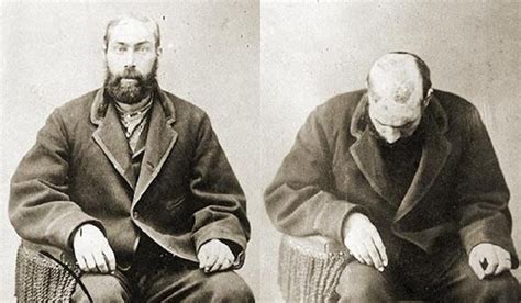 История выживания человека после снятия скальпа