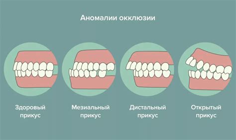 Типы аномалий